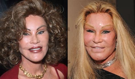 9 Celebrities Who Had Plastic Surgeries That Turned Out To Be Disasters