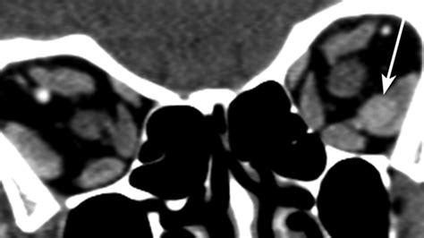 Carcinoid Tumor Metastases To The Extraocular Muscles Mr Imaging And