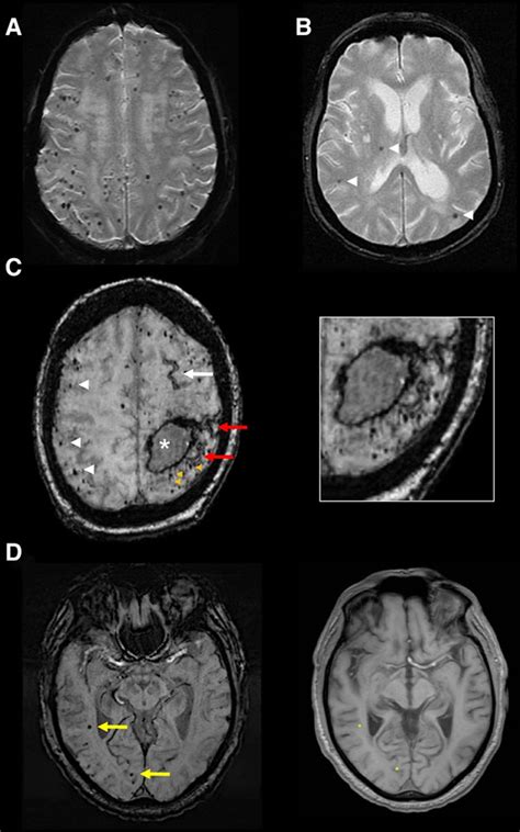 Diagnosis Of Cerebral Amyloid Angiopathy Stroke