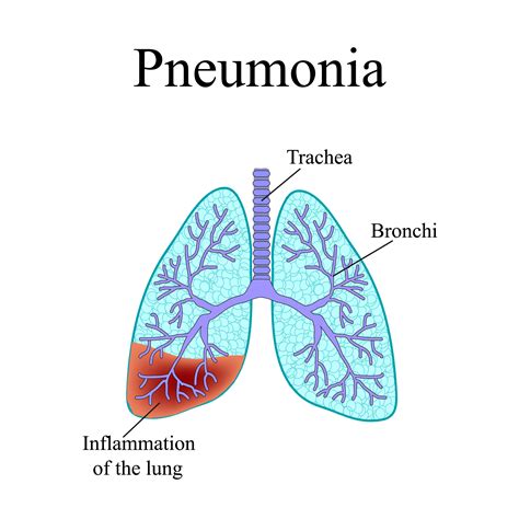 Classification Of Pneumonia