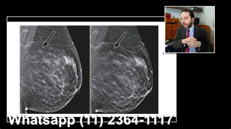 Dr Felipe Ades Rastreamento Do Câncer De Mama Mamografia Youtube