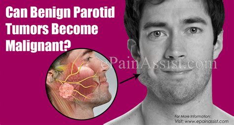 Can Benign Parotid Tumors Become Malignant And How Big Are Tumors