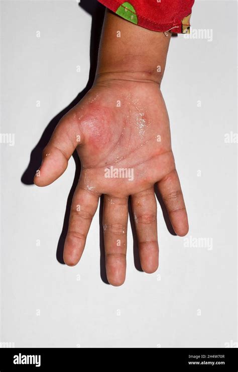 Unilateral Edema With Scabies Of Upper Limb Swollen Hand And Arm Of