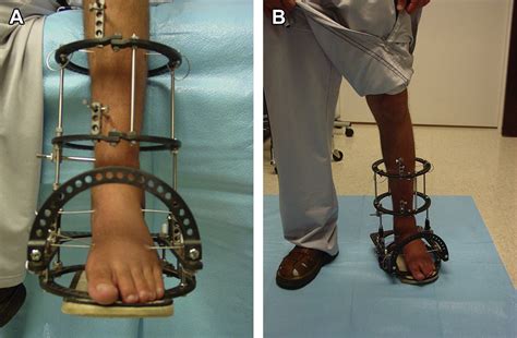 Ankle Joint Distraction Arthroplasty Foot And Ankle Clinics