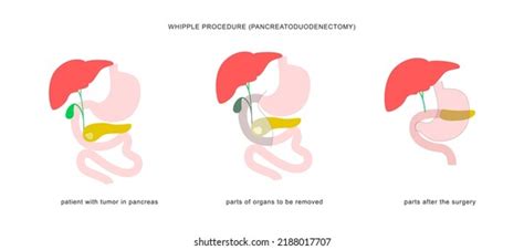 11 Afbeeldingen Voor Pancreaticoduodenectomy Afbeeldingen Stockfoto‘s