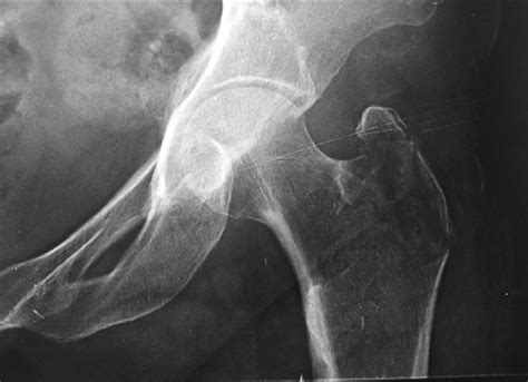 Simultaneous Bilateral Isolated Greater Trochanter Fracture Kambali M