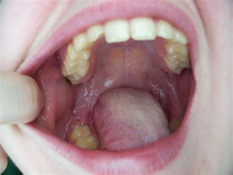 Don't eat hard, crunchy, or sticky foods that may scratch your wounds. Gum Hole | There's the hole in my gums where my third ...