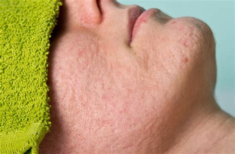 How To Get Rid Of Acne Scars Fast 9 Treatments And How They