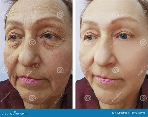 Elderly Woman`s Face Wrinkles Mature Results Contrast Before And After