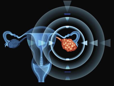 What Tests Evaluate An Ovarian Mass For Cancer