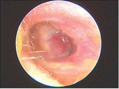 Infections Of The Ear Ento Key