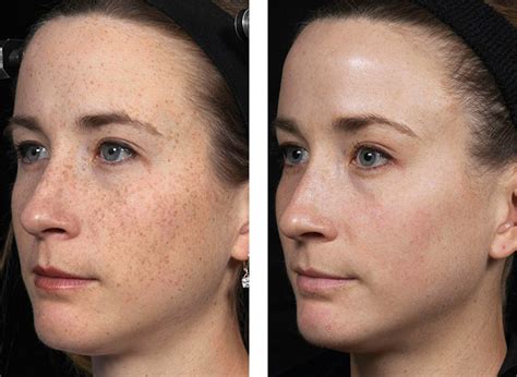 Ipl Laser Skin Rejuvenation Treatment Ipswich Before The Lines