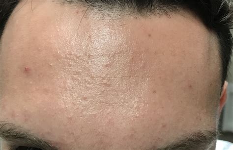 Small Bumps All Over Forehead Folliculitis General Acne Images And Photos Finder