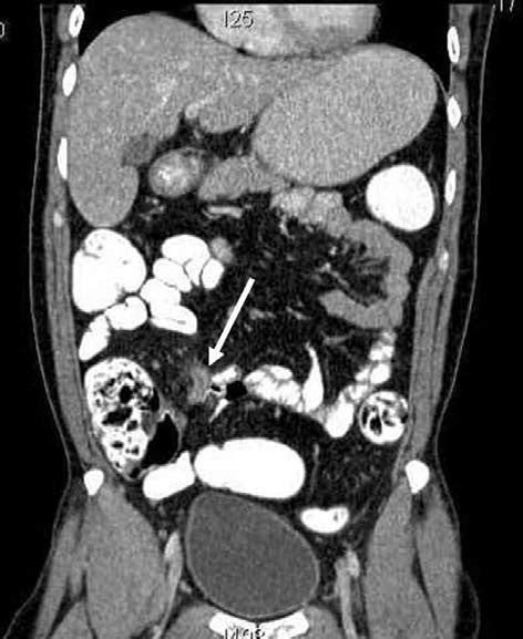 Contrast Enhanced Ct Scan With Rectal Contrast Showing An Inflamed