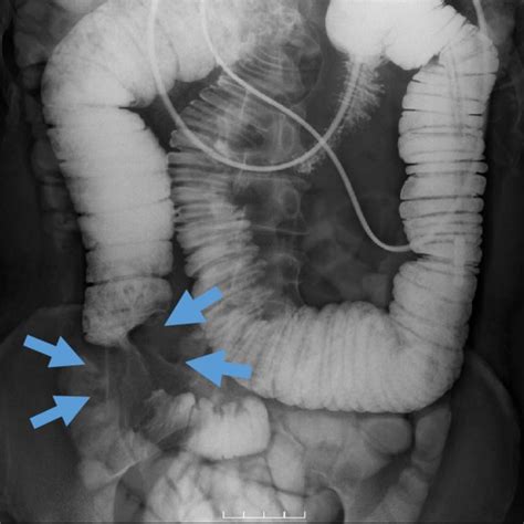 Small Bowel Series Via The Ileus Tube Shows Severe Obstruction In The Download Scientific