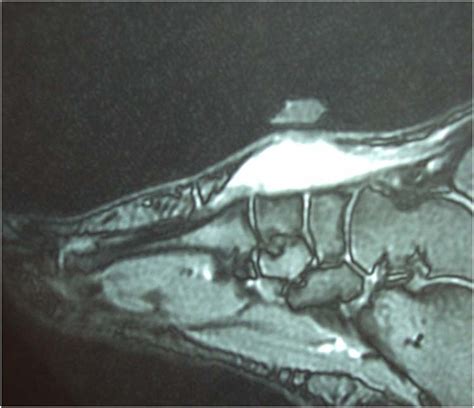 The abductor digiti minimi muscle is on the lateral side of the foot and contributes to the large lateral plantar eminence on the sole. Leiomyosarcoma of the Foot: A case report | The Foot and ...