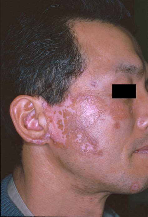 Figure 2 From Transient Effectiveness Of Dapsone For Skin Lesions In A