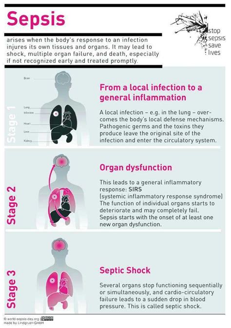 106 Best Images About Sepsis On Pinterest Health Signs Of Shock And