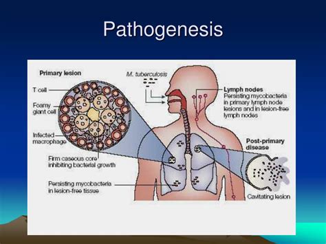 Ppt Pulmonary Tuberculosis Powerpoint Presentation Free Download