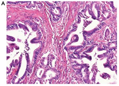 Prognostic Significance Of P16 Protein In Pancreatic Ductal Adenocarcinoma