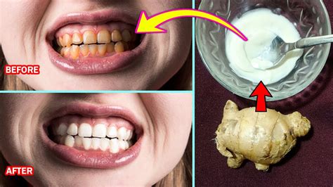 Home Remedy For Whitening Teeth Fast Get Whiter Teeth With Baking Soda