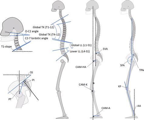 Spinopelvic Parameters And Whole Body Sagittal Alignment Parameters Aa