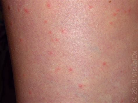 Image Iq End Of Summer Trip And A Widespread Rash Dermatology Times