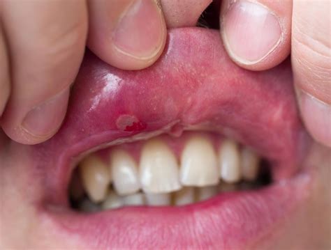 Cold Sores In Back Of Mouth