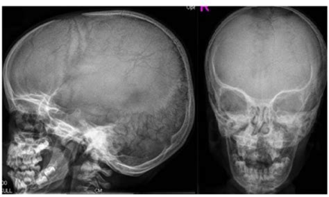 Skull Radiographs Show Brachycephalic Skull With Increa Open I
