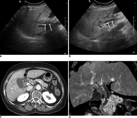 81 Year Old Woman With Duplication Of Extrahepatic Bile Duct A
