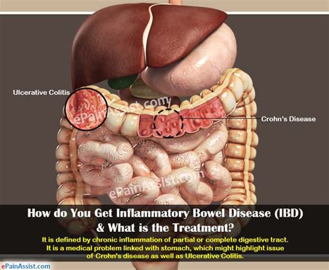 How Do You Get Inflammatory Bowel Disease IBD What Is The Treatment
