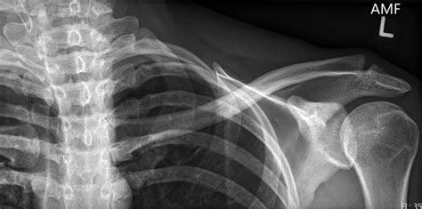 Distal Clavicle Osteolysis Wikimsk