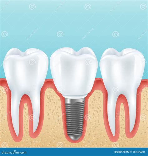 Ilustración Realista Del Implante Dental Ilustración Del Vector