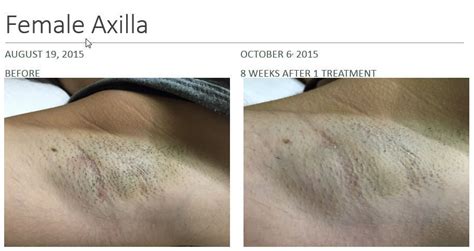 Before And After Hair Removal Photos U Day Spa Middleton Ma Medspa