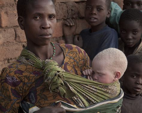 What Is Albinism Under The Same Sun