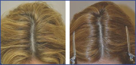 Spironolactone Hair Growth Innovative Use Of Spironolactone As An