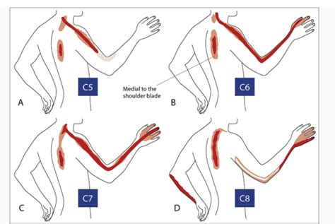 Cervical Radiculopathy Legacy Spine Neurological Specialists