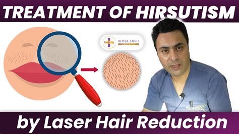 Removal Of Excess Body Hair Hirsutism By Laser Hair Reduction Causes Of Hirsutism Youtube