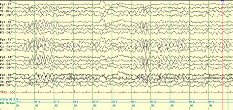 Epilepsy With Myoclonic Atonic Seizures