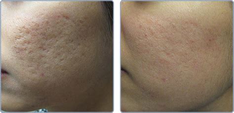 Pixel Co2 Ited Your Solution To Deep Acne Scars