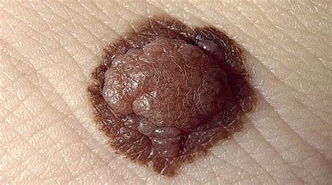 Blisters That Appear Like Black Moles Health Digest