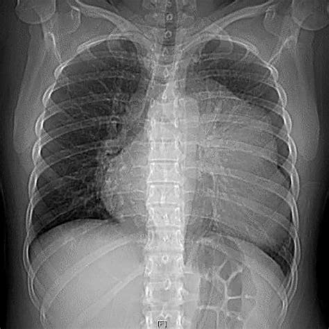 Chest X Ray Showing A Radiopaque Image At The Left Side Of The Cardiac