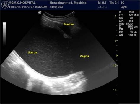 figure 4 from imperforate hymen and its complications report of two cases and review of