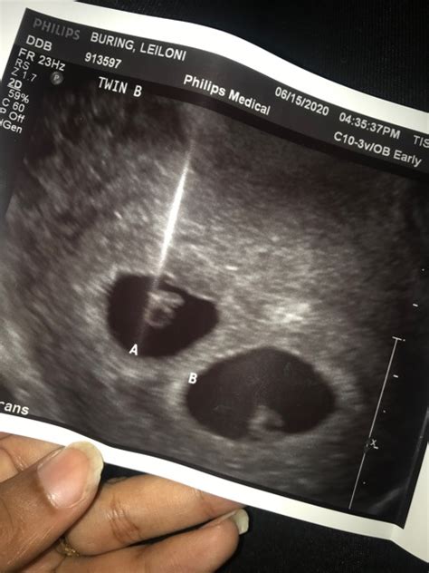 My 1st Ultrasound The Twins At 6 Weeks 🤰🏽😊💗 Glow Community