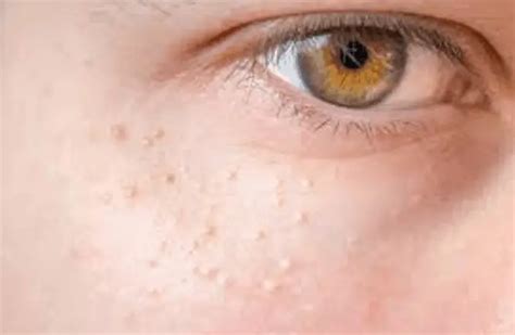 White Spots On Face And The Reasons Behind Them