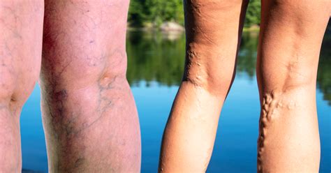 What Are Varicose Veins