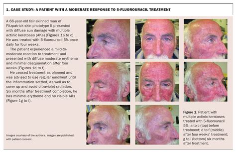 Actinic Keratoses A Guide To Treatment With 5 Fluorouracil Cream