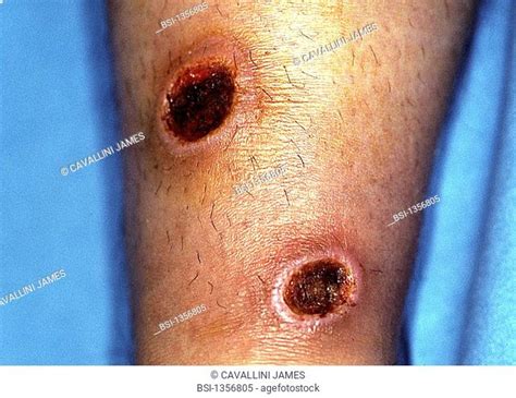 Cutaneous Leishmaniasis Lesions Stock Photos And Images Agefotostock
