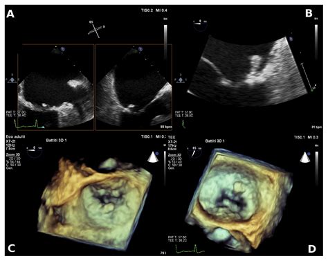 Calcified Amorphous Tumour Of The Mitral Annulus Imaged With