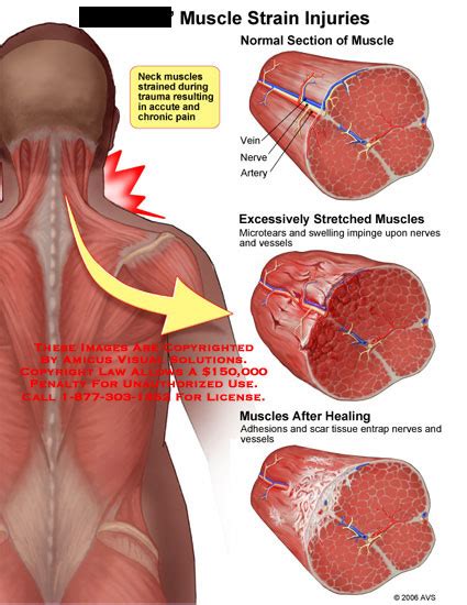 Amicus Illustration Of Amicus Injury Muscle Strain Injuries Neck Micro Tear Swelling Adhesion